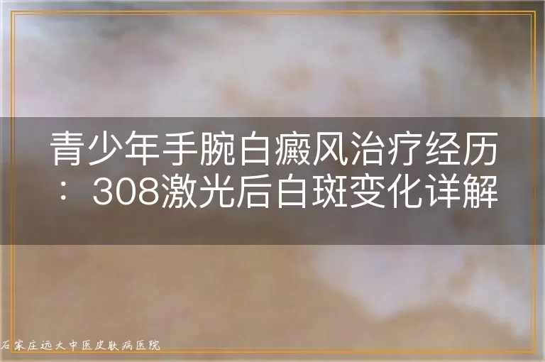 青少年手腕白癜风治疗经历：308激光后白斑变化详解