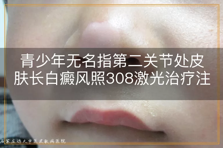 青少年无名指第二关节处皮肤长白癜风照308激光治疗注意事项