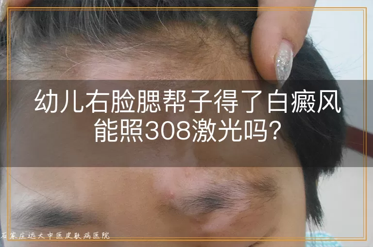 幼儿右脸腮帮子得了白癜风能照308激光吗？