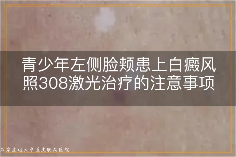青少年左侧脸颊患上白癜风照308激光治疗的注意事项