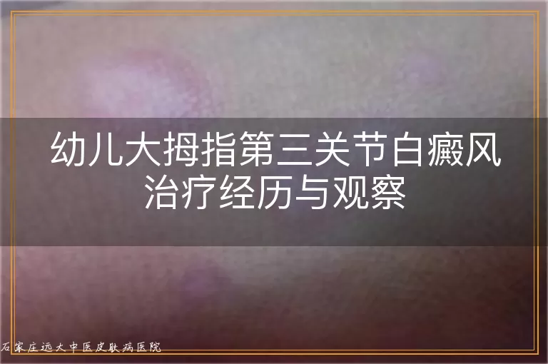 幼儿大拇指第三关节白癜风治疗经历与观察