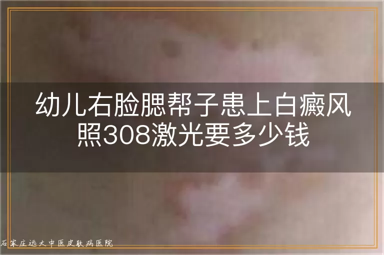 幼儿右脸腮帮子患上白癜风照308激光要多少钱