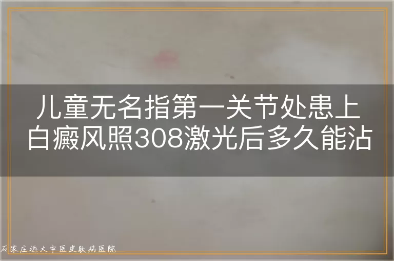 儿童无名指第一关节处患上白癜风照308激光后多久能沾水