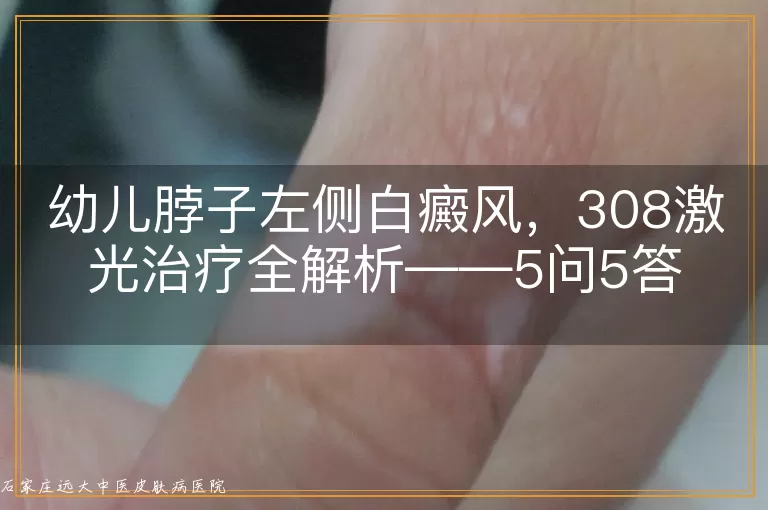 幼儿脖子左侧白癜风，308激光治疗全解析——5问5答