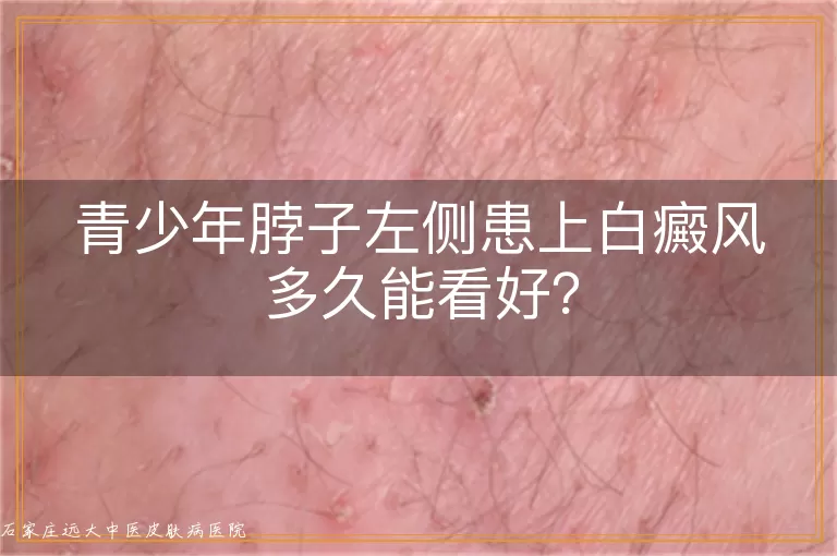 青少年脖子左侧患上白癜风多久能看好?