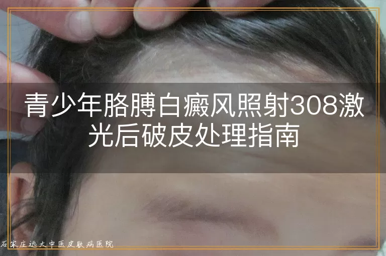 青少年胳膊白癜风照射308激光后破皮处理指南