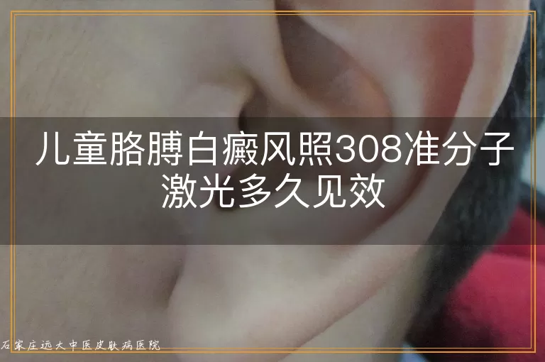 儿童胳膊白癜风照308准分子激光多久见效
