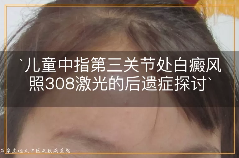 儿童中指第三关节处白癜风照308激光的后遗症探讨