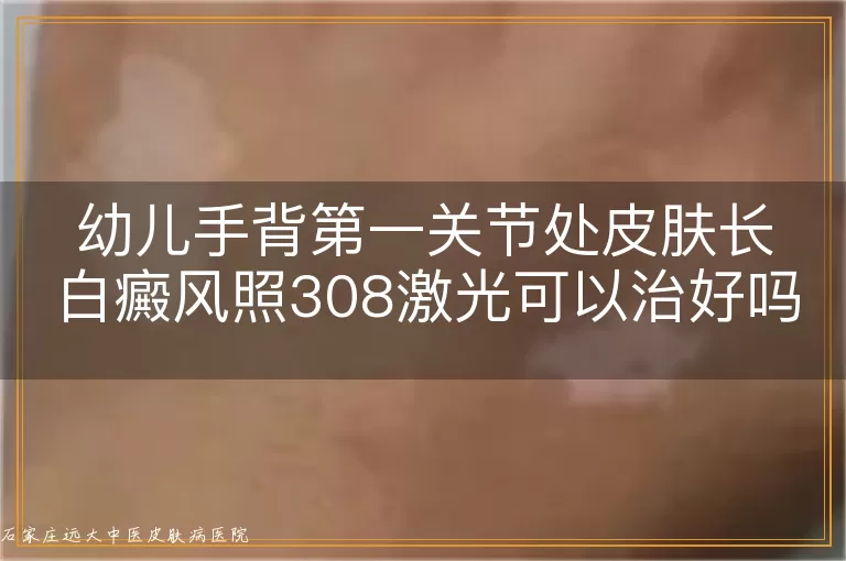 幼儿手背第一关节处皮肤长白癜风照308激光可以治好吗