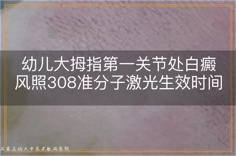 幼儿大拇指第一关节处白癜风照308准分子激光生效时间