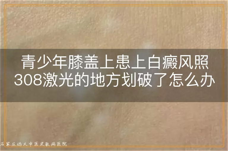 青少年膝盖上患上白癜风照308激光的地方划破了怎么办