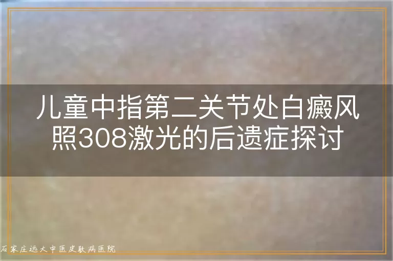 儿童中指第二关节处白癜风照308激光的后遗症探讨