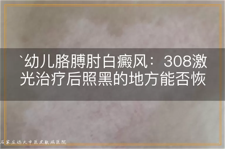 幼儿胳膊肘白癜风：308激光治疗后照黑的地方能否恢复？