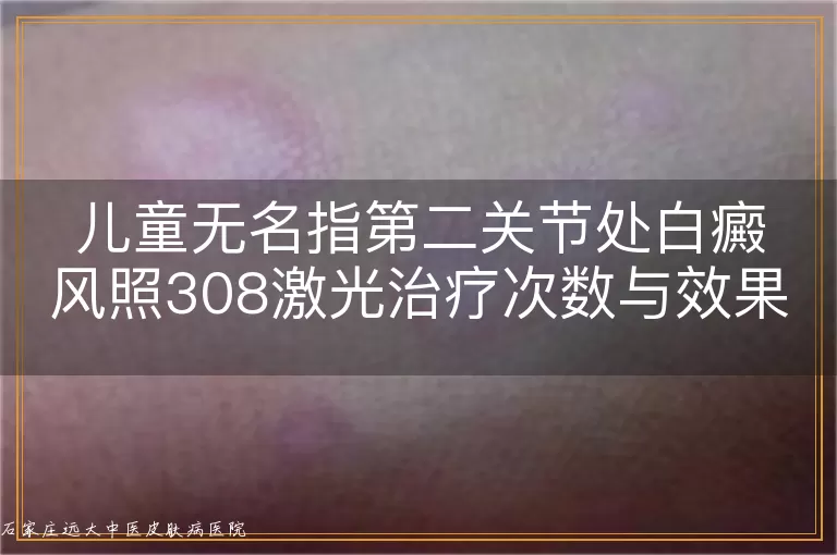 儿童无名指第二关节处白癜风照308激光治疗次数与效果