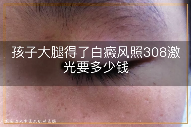 孩子大腿得了白癜风照308激光要多少钱