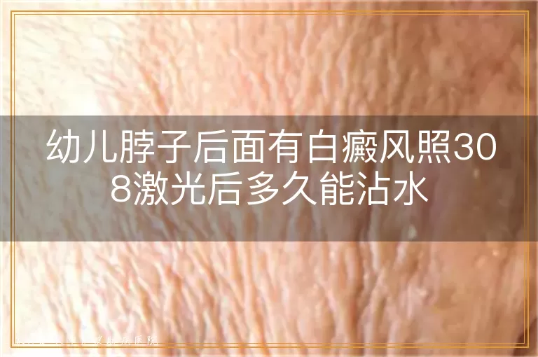 幼儿脖子后面有白癜风照308激光后多久能沾水