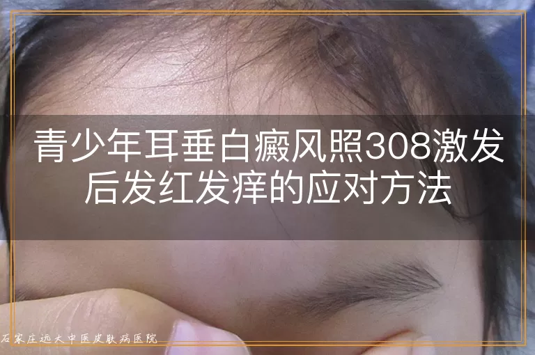 青少年耳垂白癜风照308激发后发红发痒的应对方法
