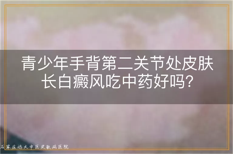 青少年手背第二关节处皮肤长白癜风吃中药好吗？