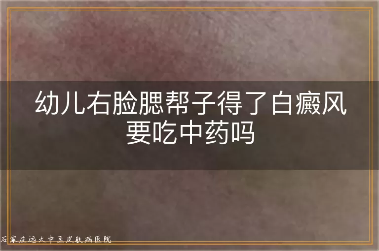 幼儿右脸腮帮子得了白癜风要吃中药吗