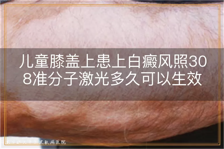 儿童膝盖上患上白癜风照308准分子激光多久可以生效