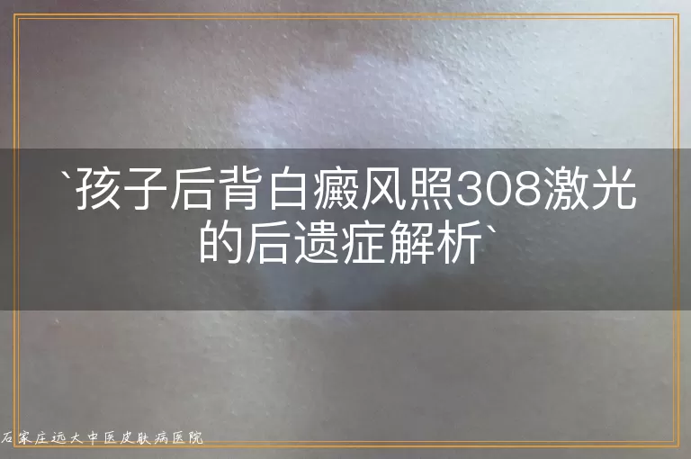 孩子后背白癜风照308激光的后遗症解析