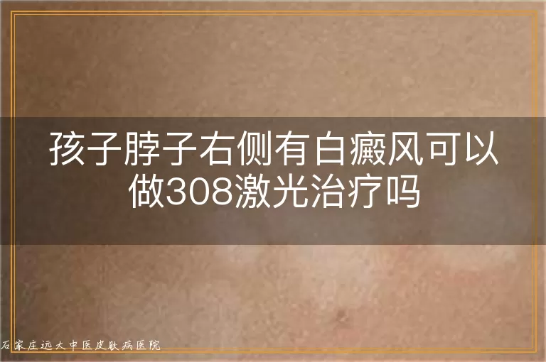 孩子脖子右侧有白癜风可以做308激光治疗吗
