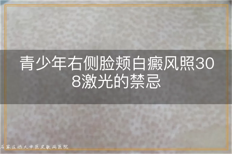 青少年右侧脸颊白癜风照308激光的禁忌