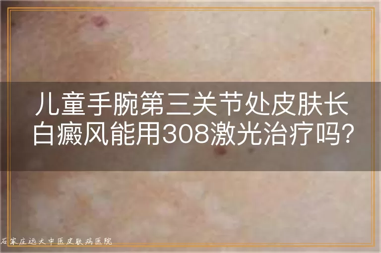儿童手腕第三关节处皮肤长白癜风能用308激光治疗吗？