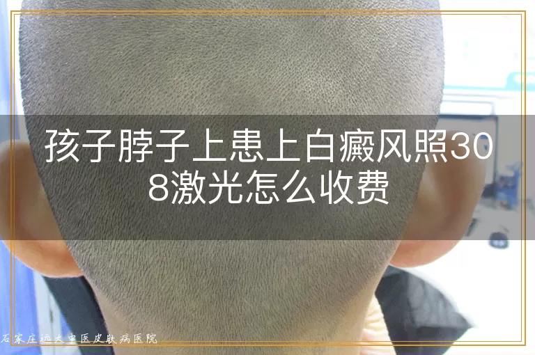 孩子脖子上患上白癜风照308激光怎么收费