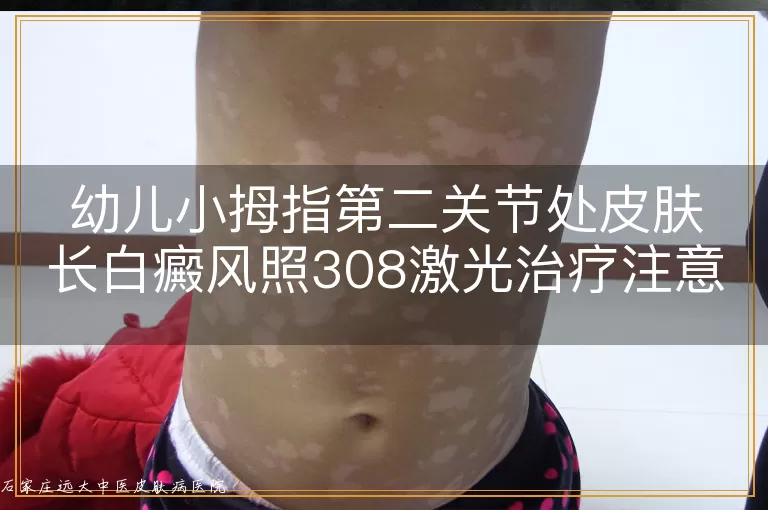 幼儿小拇指第二关节处皮肤长白癜风照308激光治疗注意事项