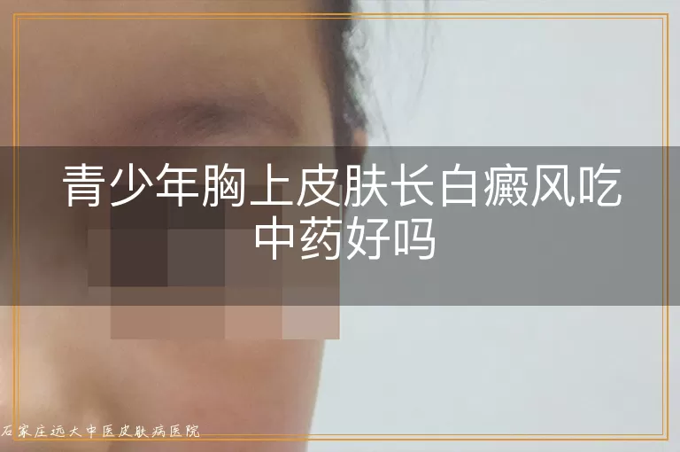 青少年胸上皮肤长白癜风吃中药好吗