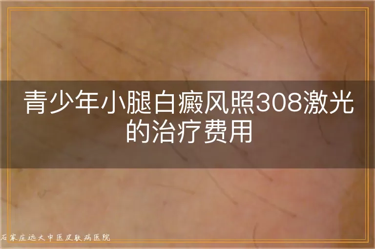 青少年小腿白癜风照308激光的治疗费用
