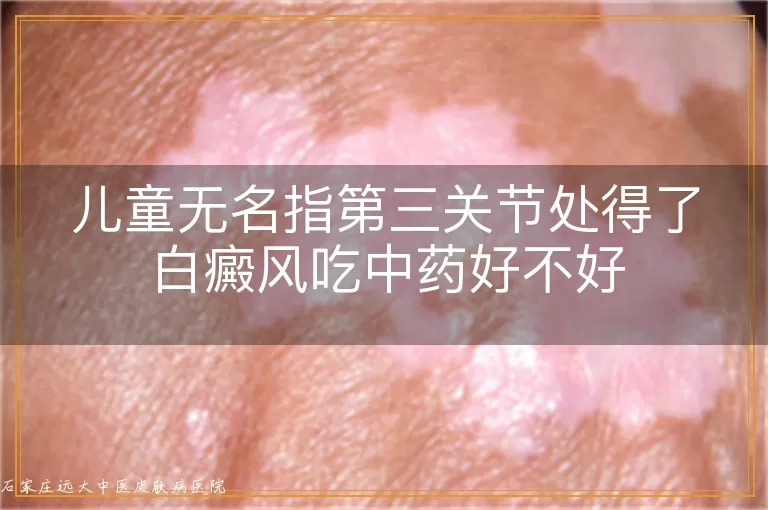 儿童无名指第三关节处得了白癜风吃中药好不好