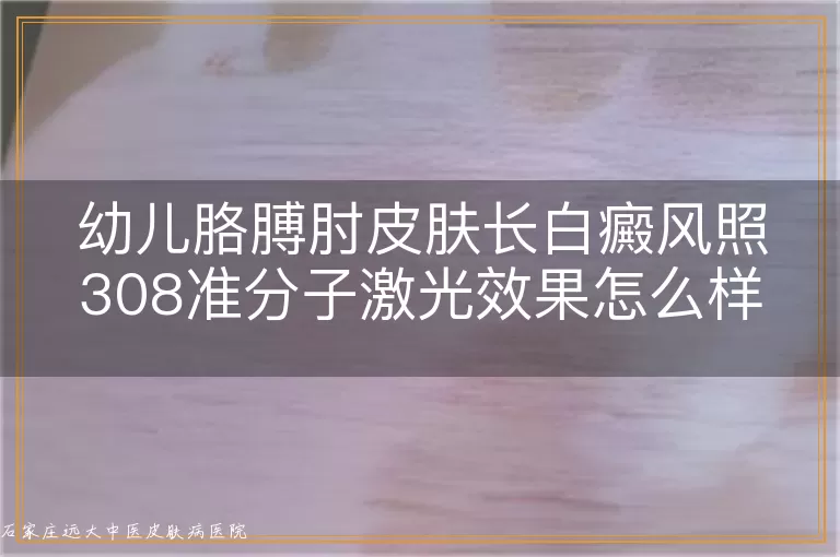 幼儿胳膊肘皮肤长白癜风照308准分子激光效果怎么样