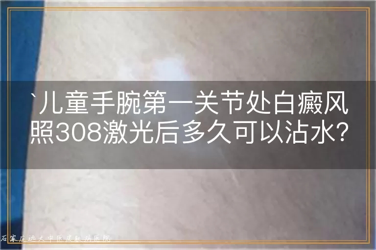 儿童手腕第一关节处白癜风照308激光后多久可以沾水？