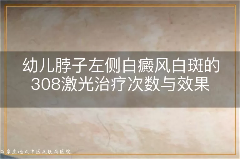 幼儿脖子左侧白癜风白斑的308激光治疗次数与效果