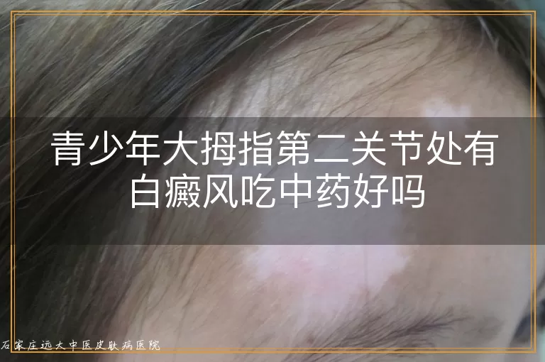 青少年大拇指第二关节处有白癜风吃中药好吗