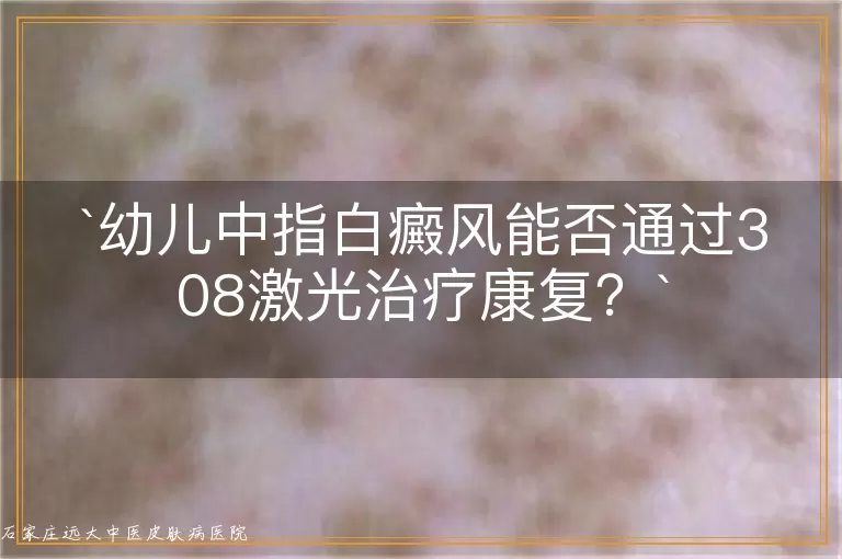 幼儿中指白癜风能否通过308激光治疗康复？