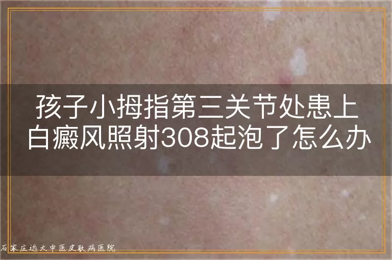 孩子小拇指第三关节处患上白癜风照射308起泡了怎么办