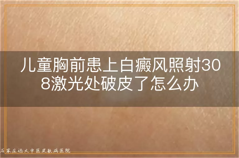 儿童胸前患上白癜风照射308激光处破皮了怎么办