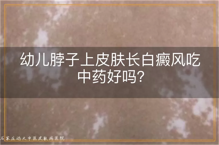 幼儿脖子上皮肤长白癜风吃中药好吗？