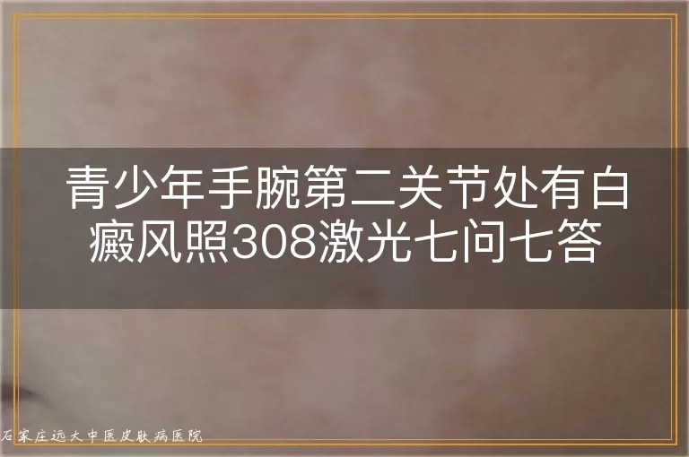 青少年手腕第二关节处有白癜风照308激光七问七答