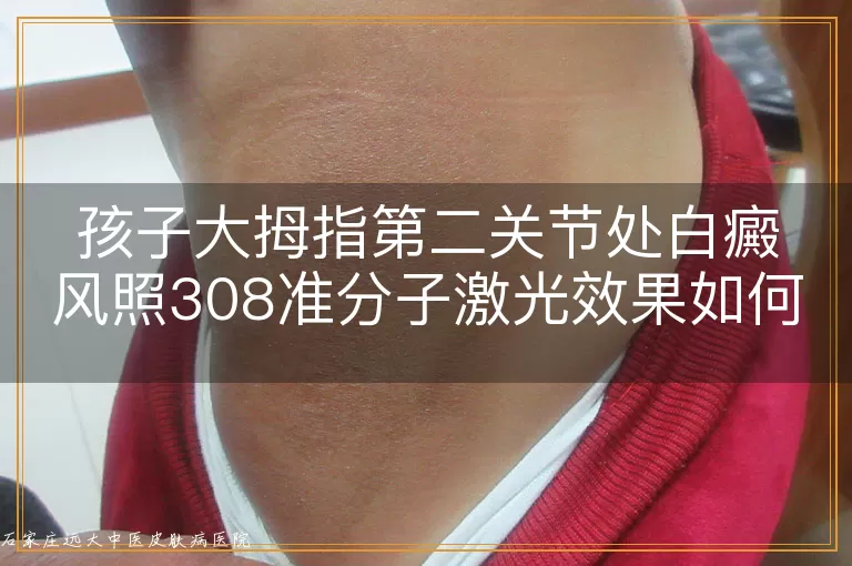 孩子大拇指第二关节处白癜风照308准分子激光效果如何？