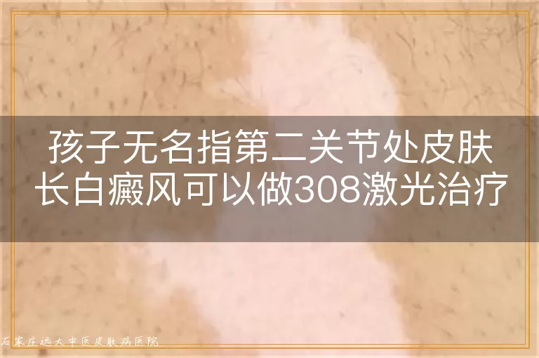 孩子无名指第二关节处皮肤长白癜风可以做308激光治疗吗