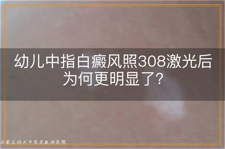 幼儿中指白癜风照308激光后为何更明显了？