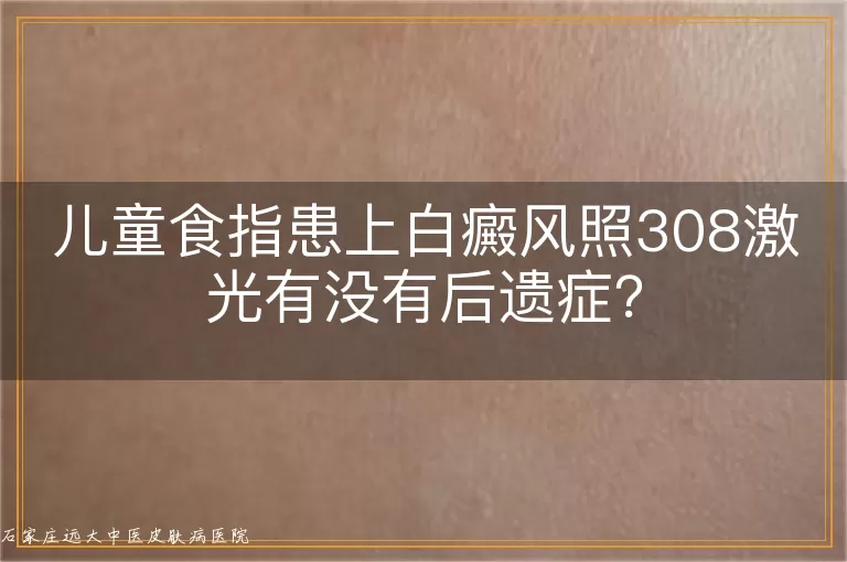 儿童食指患上白癜风照308激光有没有后遗症?