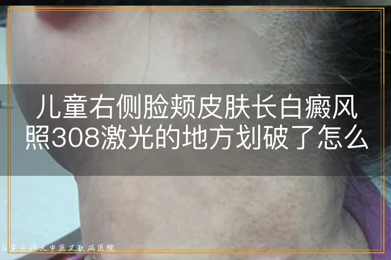 儿童右侧脸颊皮肤长白癜风照308激光的地方划破了怎么办