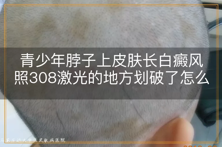 青少年脖子上皮肤长白癜风照308激光的地方划破了怎么办