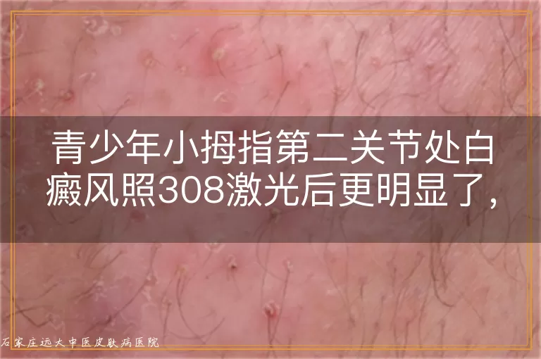 青少年小拇指第二关节处白癜风照308激光后更明显了,怎么回事?