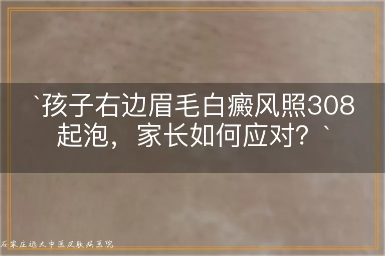 孩子右边眉毛白癜风照308起泡，家长如何应对？